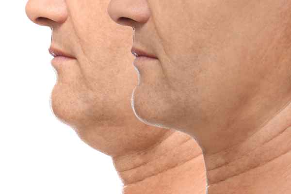 HIFU - Breakthrough in Anti - ageing 2 hifu results West Mersea