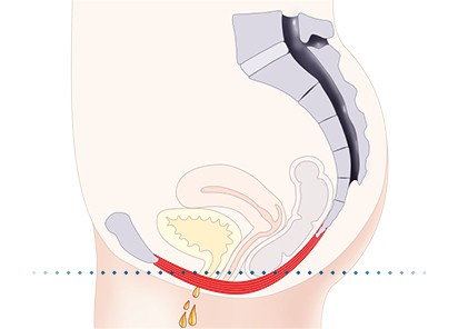 Pelvic-Floor Muscle Repair 5 Pelvic floor muscles West Mersea