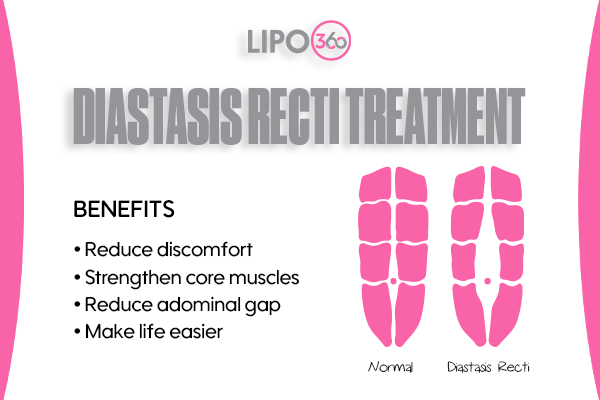 Revolutionising Muscle Repair: The Power of LIPO360 Body Sculpt Post-Injury 5 diastasis recti treatment West Mersea