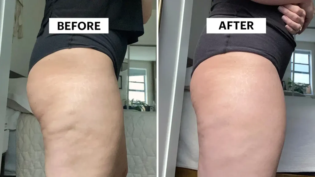Sculpting Your Bum: Can Toning Exercises Really Reduce Cellulite? 1 Do Toning Exercise West Mersea Really Tackle Cellulite?
