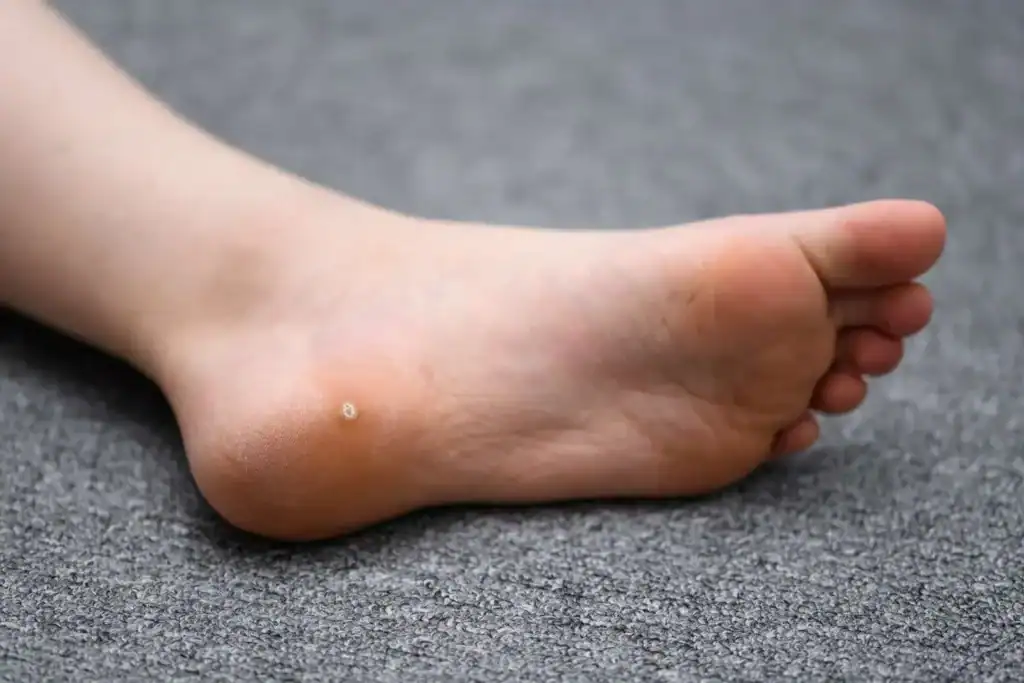 Cryotherapy For Warts And Also Verrucas 2 Image of verruca on the bottom of the foot that able to be treated with Cryotherapy West Mersea
