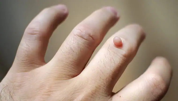Cryotherapy For Warts And Also Verrucas 1 Image of blemish that Cryotherapy West Mersea can remove with Lipo 360.
