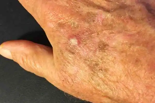 Cryopen For Actinic Keratoses 1 Image of Actinic keratoses West Mersea on a person hand