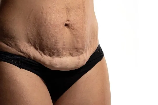 The Science of Skin Tightening 1 The science behind skin tightening West Mersea picture of a woman's sagging skin on the stomach